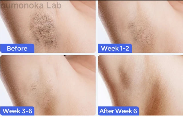 GlowSkin™ Permanent IPL laser Hair Removal