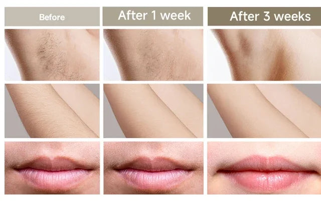 GlowSkin™ Permanent IPL laser Hair Removal